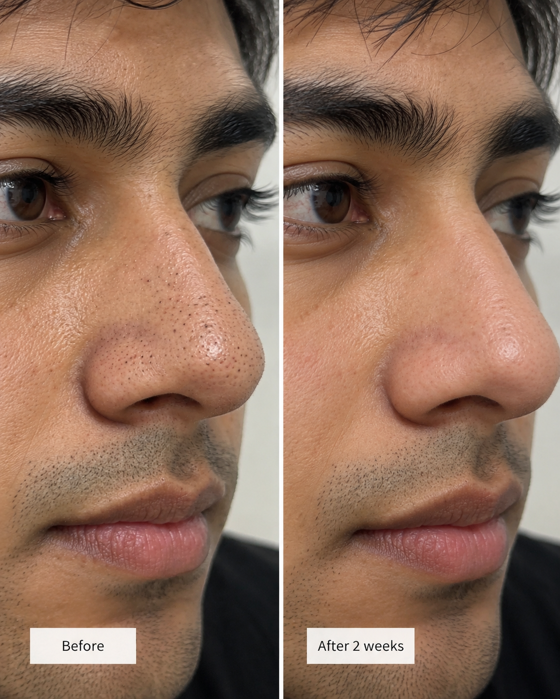 EVEEMA NOSE PATCHES FOR MEN